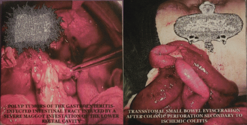 Urinary Tract Infection From Severe Pus Clots : Necrotizing Intravenous Conditions - Urinary Tract Infection From Severe Pus Clots Urinary Tract Infection From Severe Pus Clots : Necrotizing Intravenous Conditions - Urinary Tract Infection From Severe Pus Clots